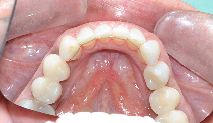 Splint contenzione - Ortodonzia definitiva
